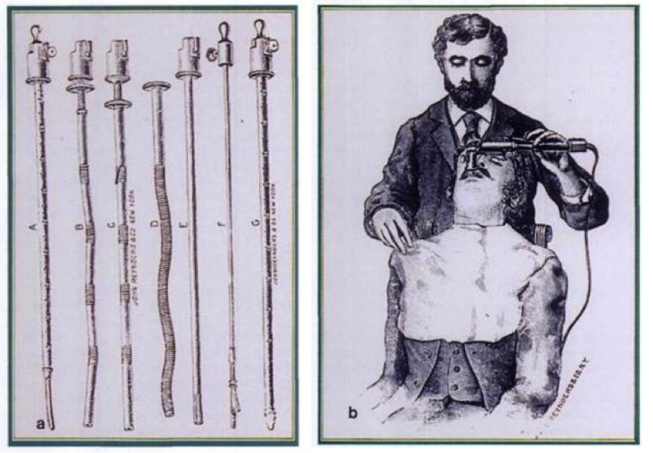 Fig. 4 : Instruments de gastroscopie au début du XXème siècle